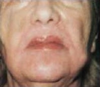 Skin Tightening after 208860