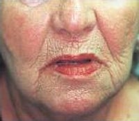 Skin Tightening before 208860
