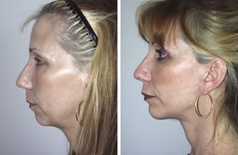 Face lift with chin implant side view before 6754
