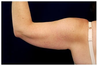 Arm Lift before 1340837
