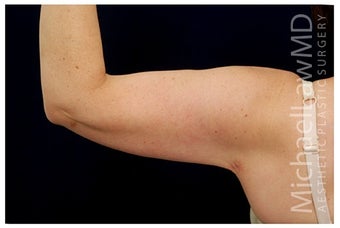 Arm Lift after 1340837