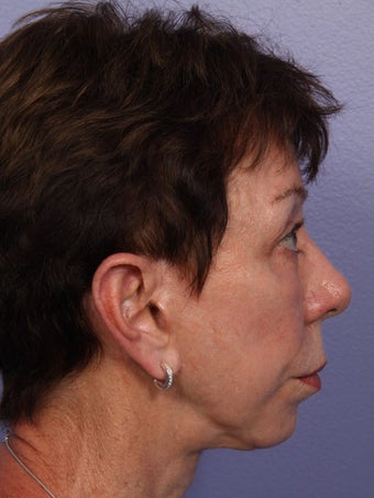 Eyelid Surgery after 280832