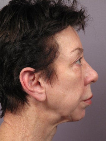 Eyelid Surgery before 280832