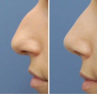 Rhinoplasty before 555766