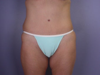 Bodylift after 653562