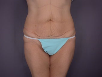 Bodylift before 653562