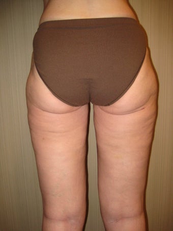 53 year old female treated for cellulite after 840659
