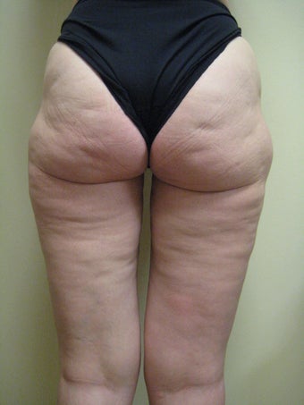 53 year old female treated for cellulite before 840659