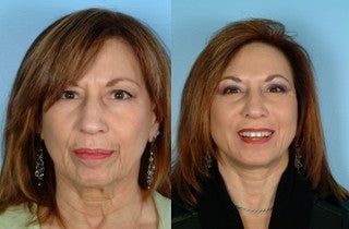 Facelift before 662852