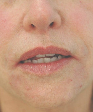 Perlane injections for chin assymmetry after 93355