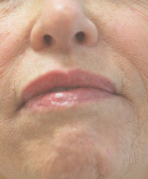Perlane injections for chin assymmetry before 93355