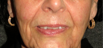 Non-surgical Lip Augmentation before 896420