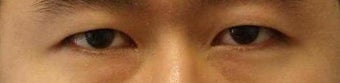 Revision Bilateral Asian Eyelid Surgery before 861211