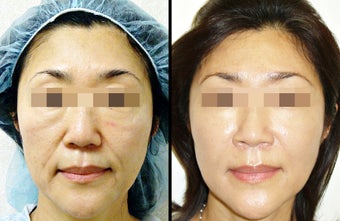 Ultherapy + Fat Transfer before 657911