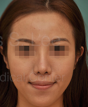 Revision Asian Nose Surgery after 815746