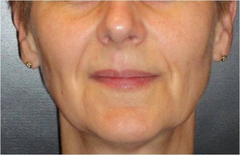 Juvederm before 686400