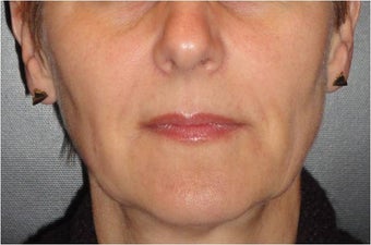 Juvederm after 686400