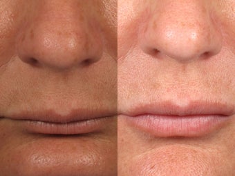 Restylane Treatment for Lip Augmentation before 1208299