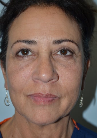 56 year old Female treated for under eye bags and prejowls around the the chin after 960946