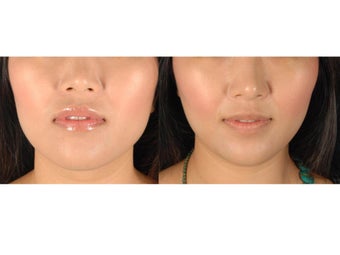 Botox Jawline Reduction before 686138