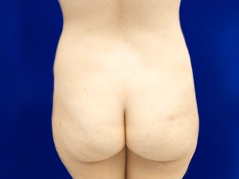 Brazilian Butt Lift Before and After before 1139912