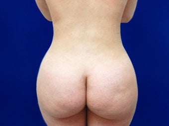 Brazilian Butt Lift Before and After after 1139912