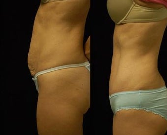 Abdominoplasty 503890