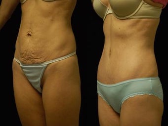 Abdominoplasty after 503890