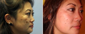 Treatment of Melasma before 666766