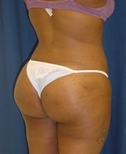 Brazilian Butt Lift Fat Injection Buttock Augmentation after 101291