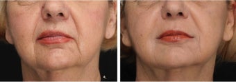 Correction of Nasolabial Folds and Marionette Lines with Restylane and Perlane before 1030387