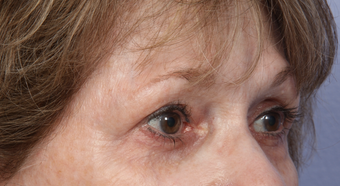 Eyelid Surgery after 302480