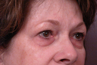 Eyelid Surgery before 302480