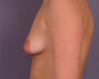 Breast Asymmetry Correction before 281323