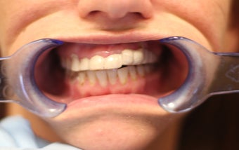 26 year old female treated with All-on-4 Dental Implant Procedure before 1053420