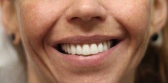 26 year old female treated with All-on-4 Dental Implant Procedure after 1053420