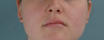 Microfat Lip Injections after 916309