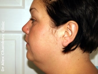 Vaser Lipo + Thread Lift to Eliminate Double Chin before 947505