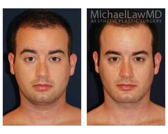 Chin Liposuction - Lower Facial Rejuvenation before 827465