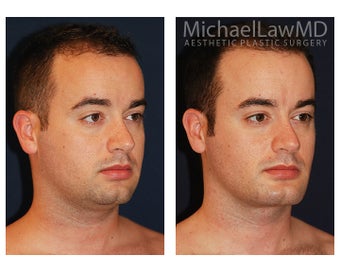 Chin Liposuction - Lower Facial Rejuvenation after 827465