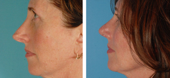 Functional Rhinoplasty before 1208304