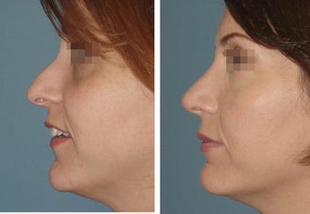 Female, Late 30's after 799853