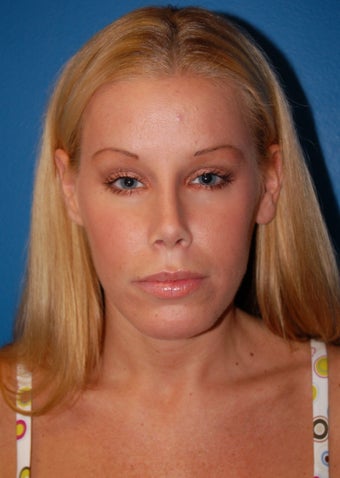 Revision Rhinoplasty after 352320