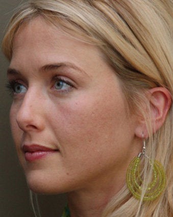 Cheek Augmentation Using Restylane before 658813