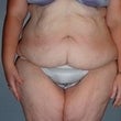 Female patient who underwent a body lift before 925308