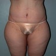 Female patient who underwent a body lift after 925308