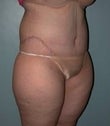 Female patient who underwent a body lift 925308