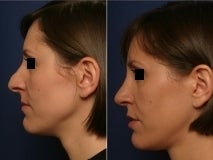 Rhinoplasty revision after 143662