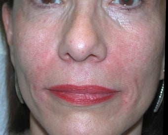 Filler - Nasal Folds after 221449
