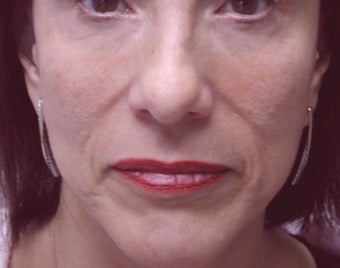 Filler - Nasal Folds before 221449